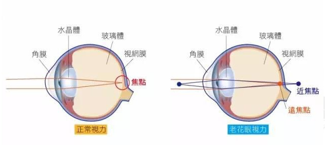 500度近視又老花，戴上美麗島多焦鏡煩惱全解決，46歲的周先生樂(lè )壞了